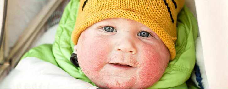 Seven Easy Tips for Dealing with your Eczema this Winter Seven Easy Tips for Dealing with your Eczema this Winter