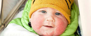 Seven Easy Tips for Dealing with your Eczema this Winter Seven Easy Tips for Dealing with your Eczema this Winter