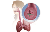 How Is Asthma Treated? How Is Asthma Treated?