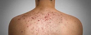 Skin Allergy Test Near Me in Lawrenceville GA, Atlanta GA, and Conyers GA