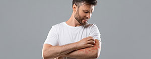 Common Causes of Eczema and How to Prevent It? | Allergy & Asthma Center Near Me in Atlanta, Lawrenceville, and Conyers, GA